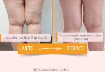 El desafío del Lipedema en la salud femenina