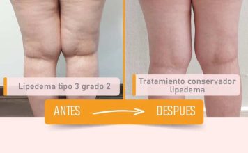El desafío del Lipedema en la salud femenina