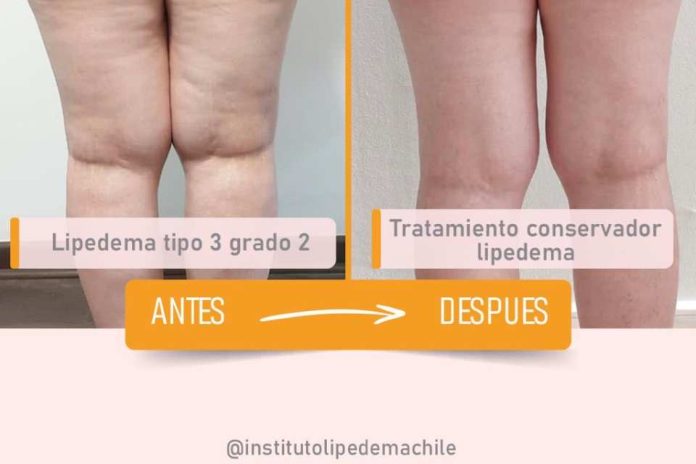 El desafío del Lipedema en la salud femenina