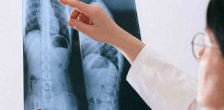 Hernias abdominales: cuándo una simple protuberancia puede volverse una emergencia