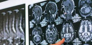 Día Mundial del Cerebro: Hasta el 90% de algunos ACV podrían prevenirse