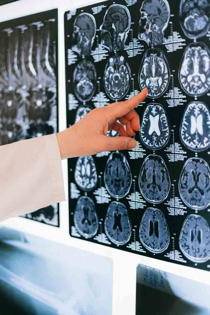 Día Mundial del Cerebro: Hasta el 90% de algunos ACV podrían prevenirse