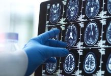 China | 'Una persona completamente nueva': ¿puede la cirugía ayudar a los pacientes con Alzheimer a recuperar habilidades básicas?