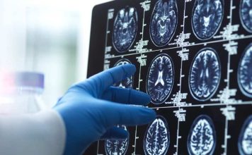 China | 'Una persona completamente nueva': ¿puede la cirugía ayudar a los pacientes con Alzheimer a recuperar habilidades básicas?
