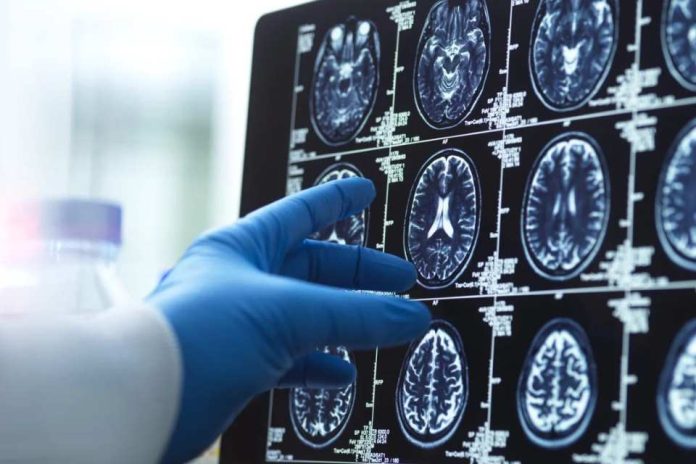 China | 'Una persona completamente nueva': ¿puede la cirugía ayudar a los pacientes con Alzheimer a recuperar habilidades básicas?