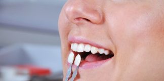 ¿Pensando en carillas dentales? Odontólogo explica los riesgos y los mitos en torno a este procedimiento