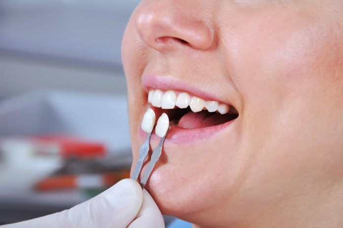 ¿Pensando en carillas dentales? Odontólogo explica los riesgos y los mitos en torno a este procedimiento