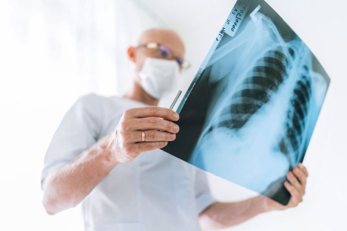 Qué debemos saber sobre la tuberculosis