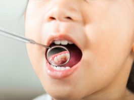 Radiografía a la salud buco dental de las niñas y niños en Chile