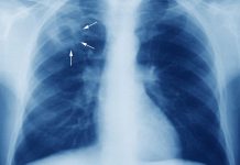 Tuberculosis. Casos en Concepción y Coquimbo reactivan la vigilancia por Tuberculosis: ¿Cuál es el panorama real en Chile?