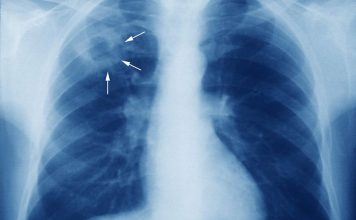 Tuberculosis. Casos en Concepción y Coquimbo reactivan la vigilancia por Tuberculosis: ¿Cuál es el panorama real en Chile? Tuberculosis. Casos en Concepción y Coquimbo reactivan la vigilancia por Tuberculosis: ¿Cuál es el panorama real en Chile?