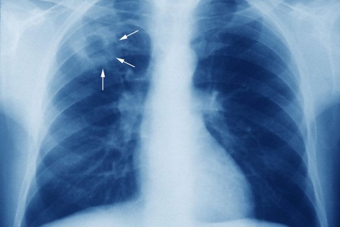 Tuberculosis. Casos en Concepción y Coquimbo reactivan la vigilancia por Tuberculosis ¿Cuál es el panorama real en Chile Tuberculosis. Casos en Concepción y Coquimbo reactivan la vigilancia por Tuberculosis: ¿Cuál es el panorama real en Chile?