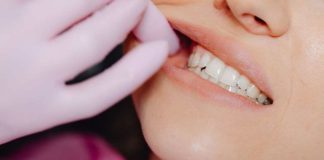 ¿Te sangran las encías Podría ser gingivitis y no lo debes normalizar