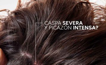 ¿Tienes algún tipo de caspa y no sabes cómo controlarla? ¿Tienes algún tipo de caspa y no sabes cómo controlarla?