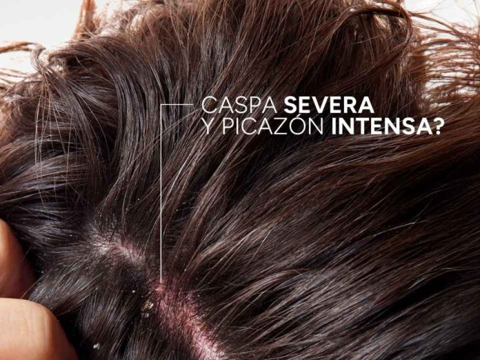¿Tienes algún tipo de caspa y no sabes cómo controlarla?