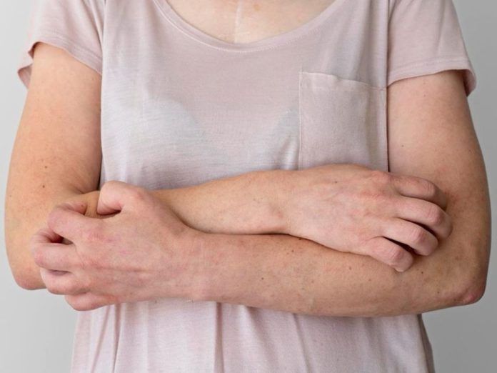 Día Mundial de la Dermatitis Atópica: 8 de cada 10 casos en mujeres aparecen por primera vez durante el embarazo