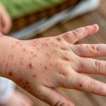 Varicela: prevenir sigue siendo fundamental