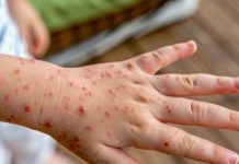 Varicela: prevenir sigue siendo fundamental