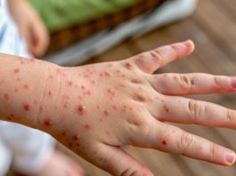Varicela: prevenir sigue siendo fundamental Varicela: prevenir sigue siendo fundamental
