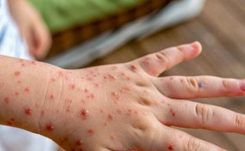 Varicela: prevenir sigue siendo fundamental