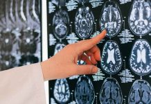 Día Mundial del ACV: cada minuto sin tratamiento se pierden dos millones de neuronas