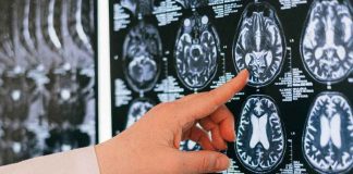 Día Mundial del ACV: cada minuto sin tratamiento se pierden dos millones de neuronas Día Mundial del ACV: cada minuto sin tratamiento se pierden dos millones de neuronas