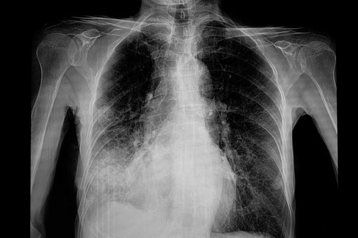 neumonia Peste neumónica en Siberia: por qué su letalidad no equivale a riesgo de pandemia