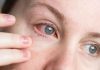 ¿Ojo rojo?: Cómo distinguir una alergia de una infección y cuándo consultar a un especialista