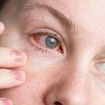 ¿Ojo rojo?: Cómo distinguir una alergia de una infección y cuándo consultar a un especialista