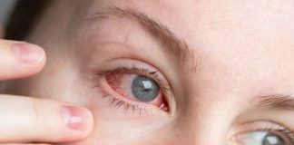 ¿Ojo rojo?: Cómo distinguir una alergia de una infección y cuándo consultar a un especialista ¿Ojo rojo?: Cómo distinguir una alergia de una infección y cuándo consultar a un especialista